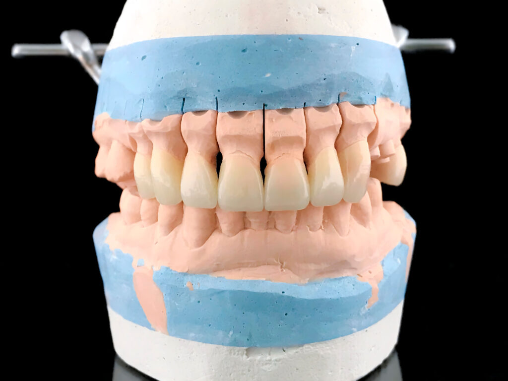 vantagens do zircónio nos tratamentos dentários